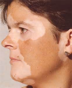 vitiligo2.jpg